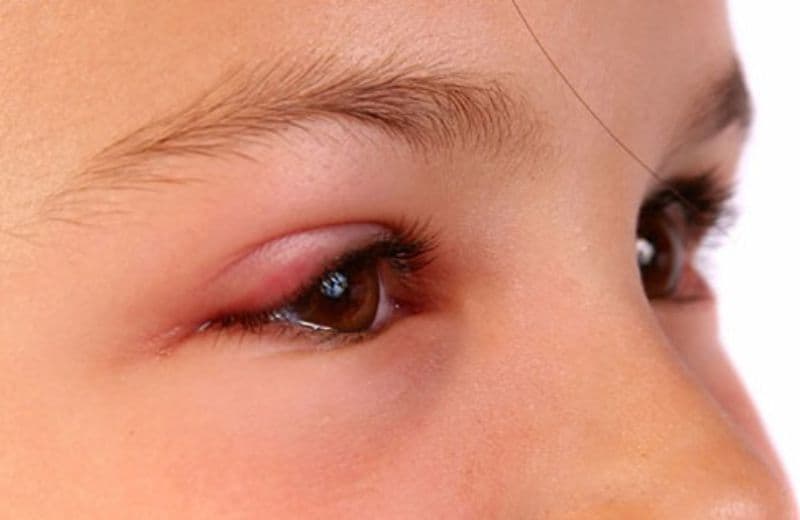 4 Cách khắc phục và chăm sóc mắt sau khi xăm mí bị sưng mắt